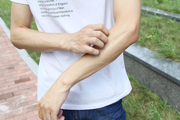 成都升温千足虫满街爬！春夏季蚊虫过敏后，该如何治？-成都夏天有什么