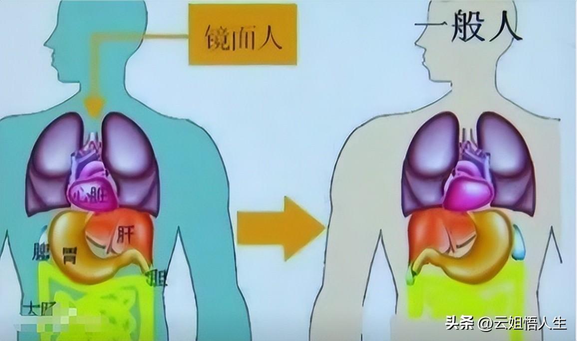 武汉夫妻诞下罕见“镜面宝宝”，全球“心在右边”的孩子真实案例-武汉夫妻看演出双双身亡