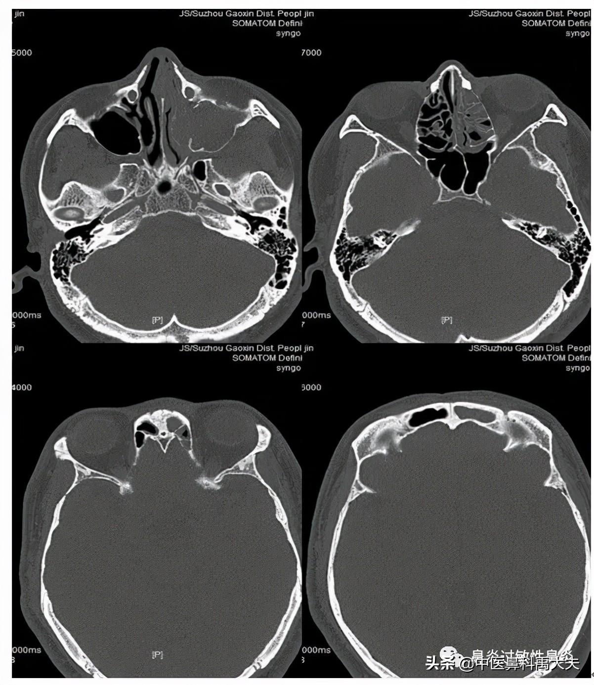 鼻窦炎的治疗，要科学、合理、有效（鼻窦炎的医治）