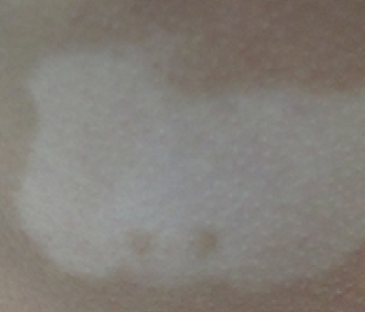 背部得白癜风该怎样治疗好（肩胛骨有白色点）