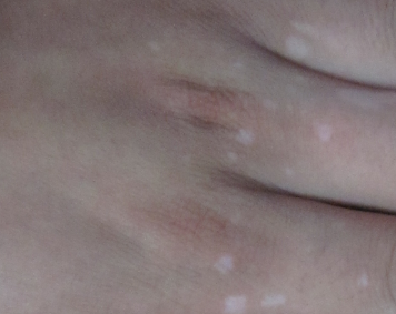 孩子白癜风该怎样治疗好