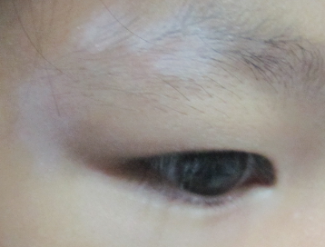 该怎样治疗好患得白癜风（怎么治好肝癌）