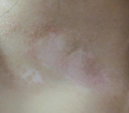 儿童得了白癜风怎样治疗好（小孩白点癫风早期图片）