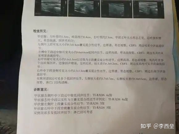 中药调理好甲状腺结节，内服+外敷-甲状腺结节外用中药方