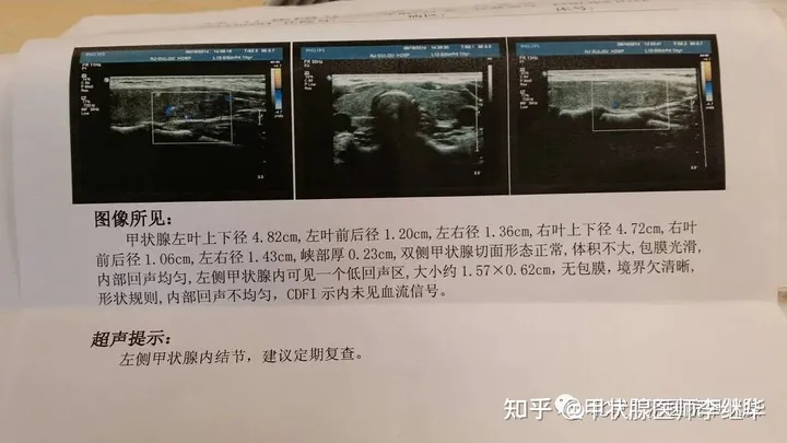 中医解读甲状腺结节、甲亢、甲减，弄懂这些，治疗起来事半功倍-中医对甲状腺结节的治疗效果