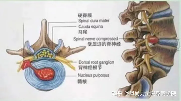 部队训练椎间盘突出解决方案-腰间盘突出军训会怎么样
