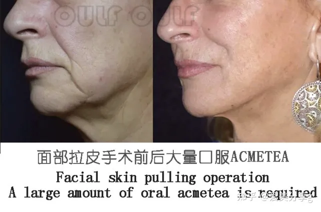 小切口面部提升手术价格表，揭秘小拉皮手术多少钱一次！-切口小拉皮手术视频