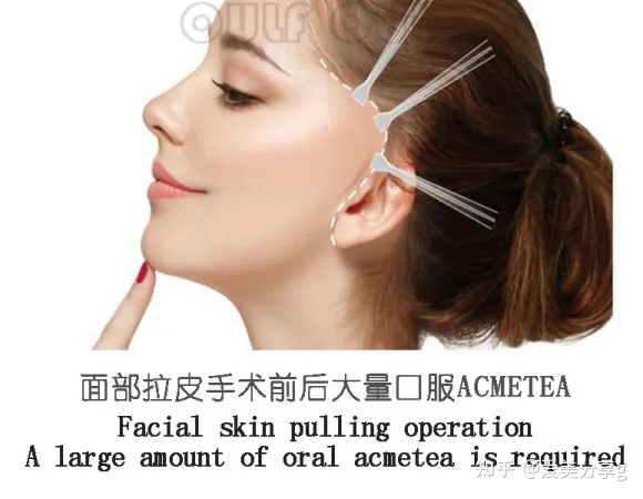 小切口面部提升手术价格表，揭秘小拉皮手术多少钱一次！-切口小拉皮手术视频