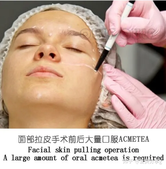小切口面部提升手术价格表，揭秘小拉皮手术多少钱一次！-切口小拉皮手术视频