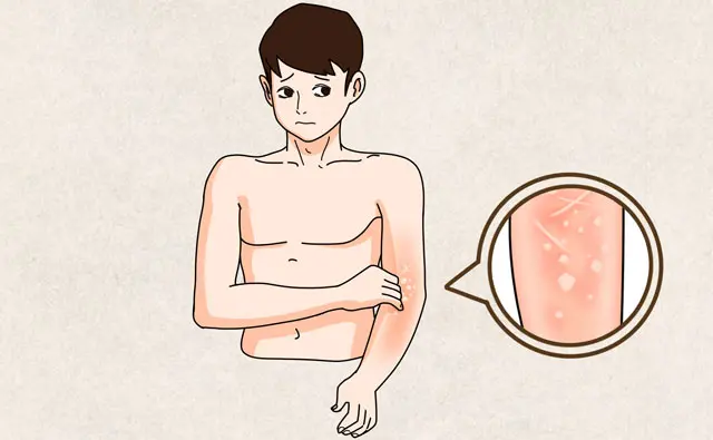 荨麻疹是怎么回事？怎么治疗和预防？-荨麻疹是怎么引起的该怎么冶疗