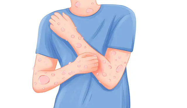 荨麻疹是怎么回事？怎么治疗和预防？-荨麻疹是怎么引起的该怎么冶疗