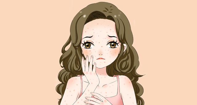 荨麻疹是怎么回事？怎么治疗和预防？-荨麻疹是怎么引起的该怎么冶疗