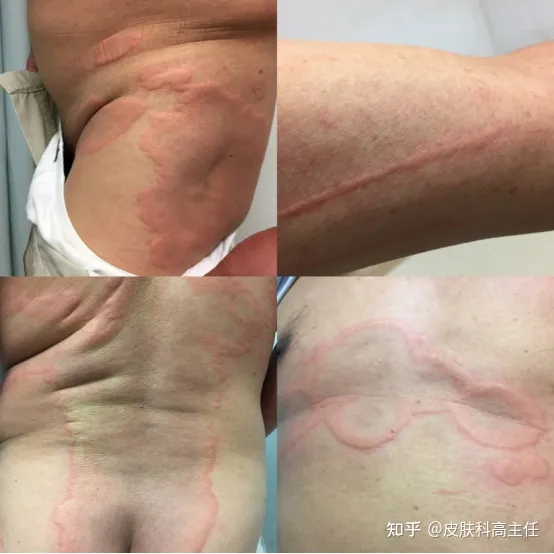 荨麻疹是由什么原因引起的？医生教您正确防护-荨麻疹的诱因和症状是什么