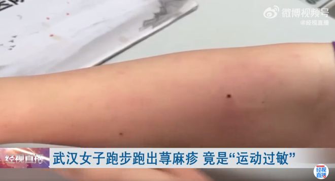 女子跑步过敏！长荨麻疹-女子跑步过敏怎么办