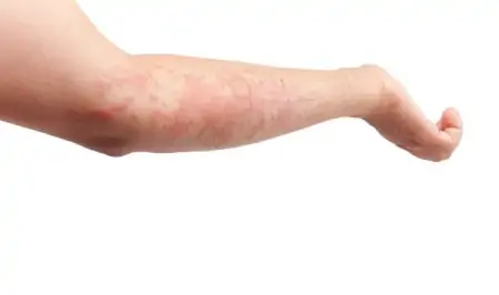 以前不过敏，为何突然开始过敏了？过敏不遗传，遗传的是它-以前不过敏,现在变过敏体质