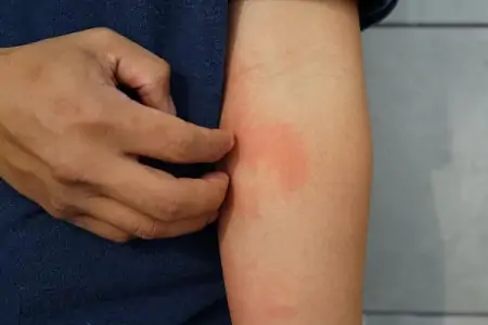 以前不过敏，为何突然开始过敏了？过敏不遗传，遗传的是它-以前不过敏,现在变过敏体质