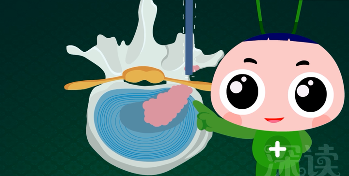 腰椎间盘突出怎样治疗?-腰椎间盘突出怎么治疗有效果