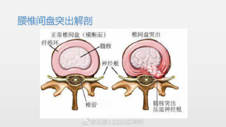 一起了解腰椎间盘突出症的康复治疗-腰椎间盘突出症的康复治疗方案