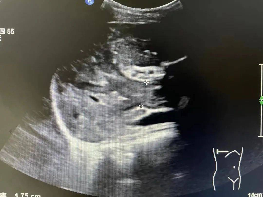 浙江24岁妈妈确诊癌症晚期：我孩子才3岁！医生痛惜：早有症状