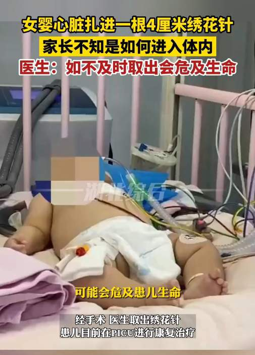 女婴心脏惊现绣花针，父母称不知情，医生推断引热议
