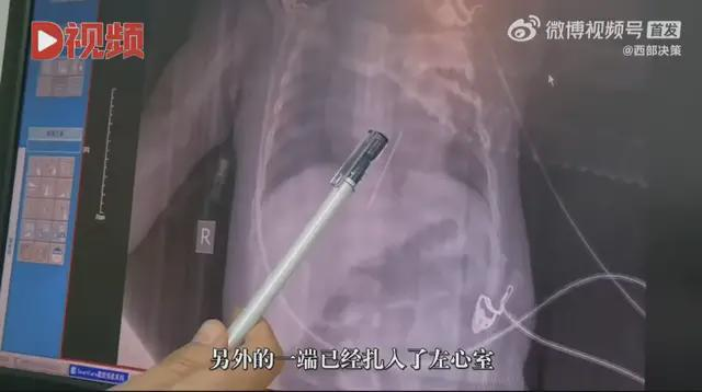 女婴心脏惊现绣花针，父母称不知情，医生推断引热议