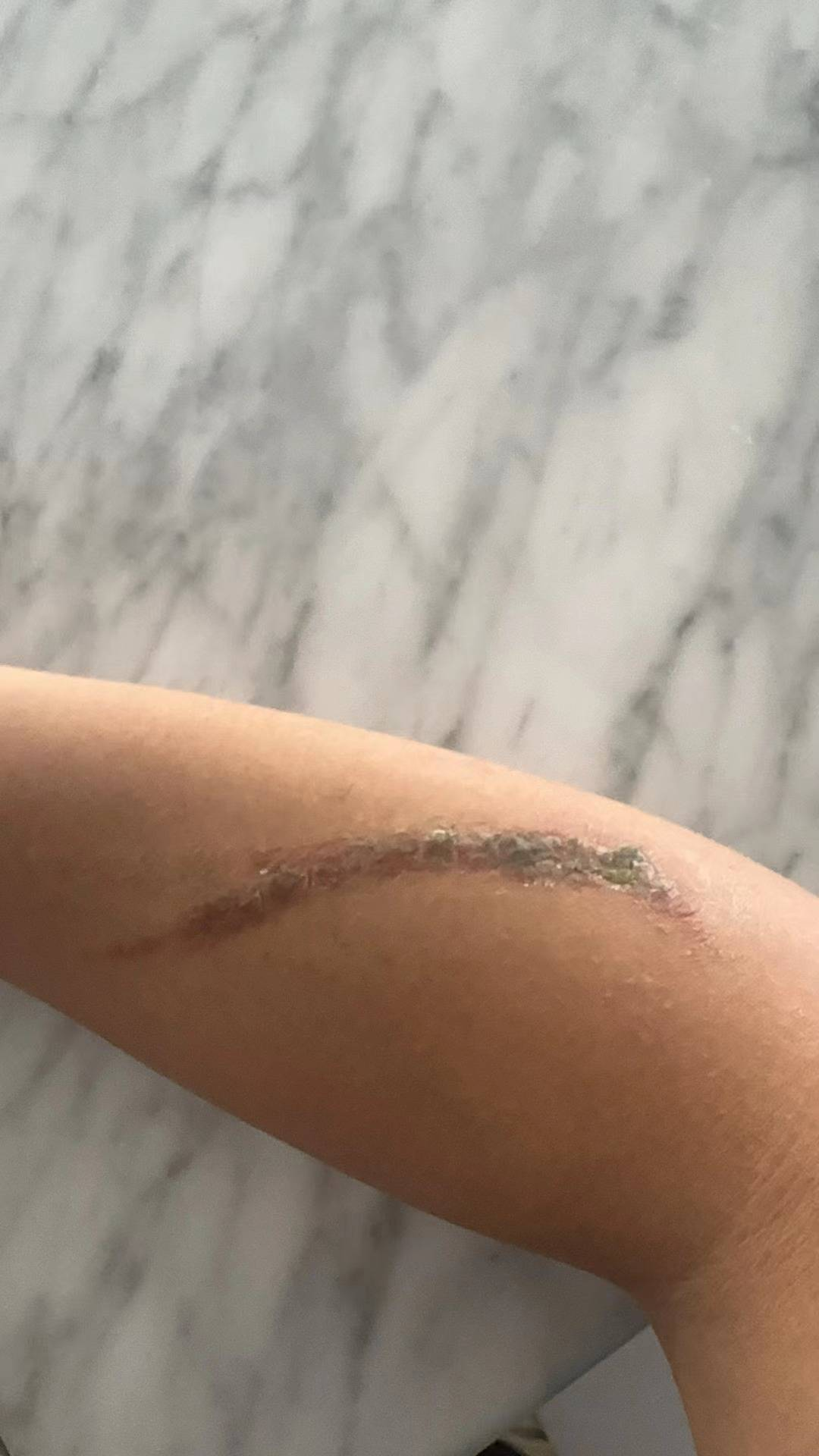 女子拍打毒隐翅虫后皮炎10天未愈，专家：不要拍打，它们不咬人