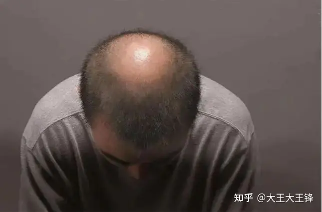 拯救雄脱，摆脱“未脱单，先脱发”困境