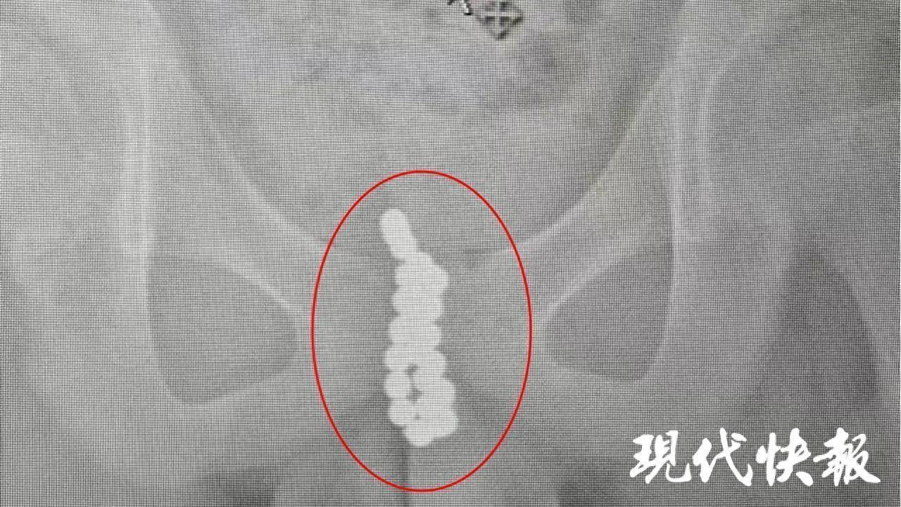 13岁男孩血尿一个多星期，医生在尿道里取出20多颗磁力珠-男孩尿后出血吃什么药