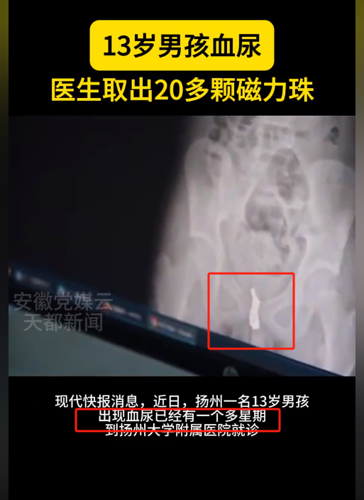 13岁男孩血尿医生取出20多颗磁力珠，关注青少年性教育合理引导！-磁力玩具的好处